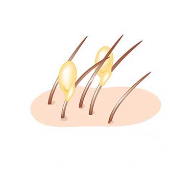 Illustration of Lice eggs for Lice Sisters Lice Removal Birmingham website nit glue dissolver